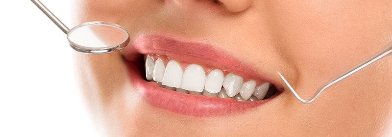 Dental Fillings