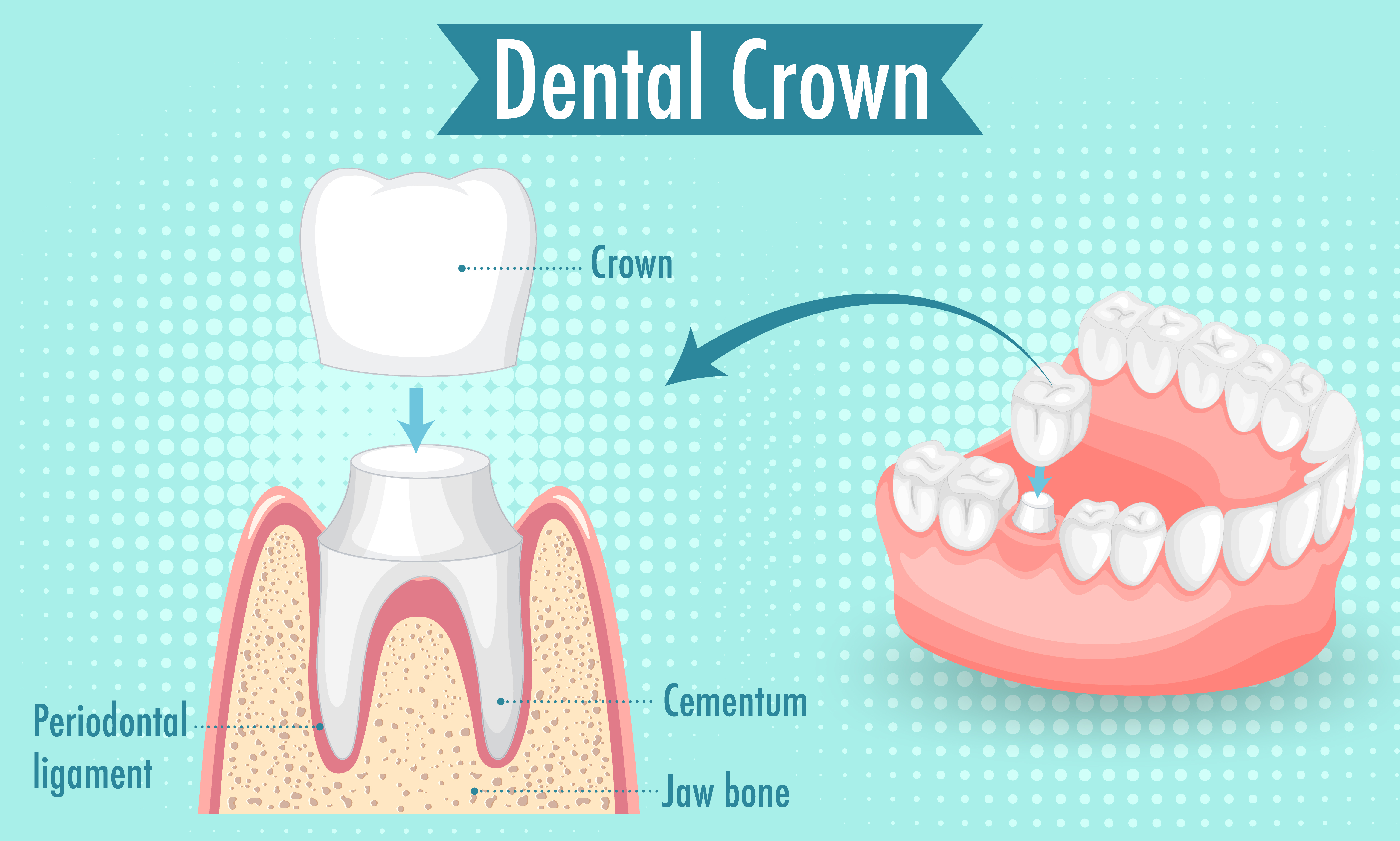 Crowns and bridges