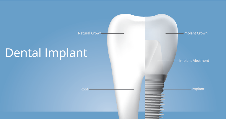 Dental Implant