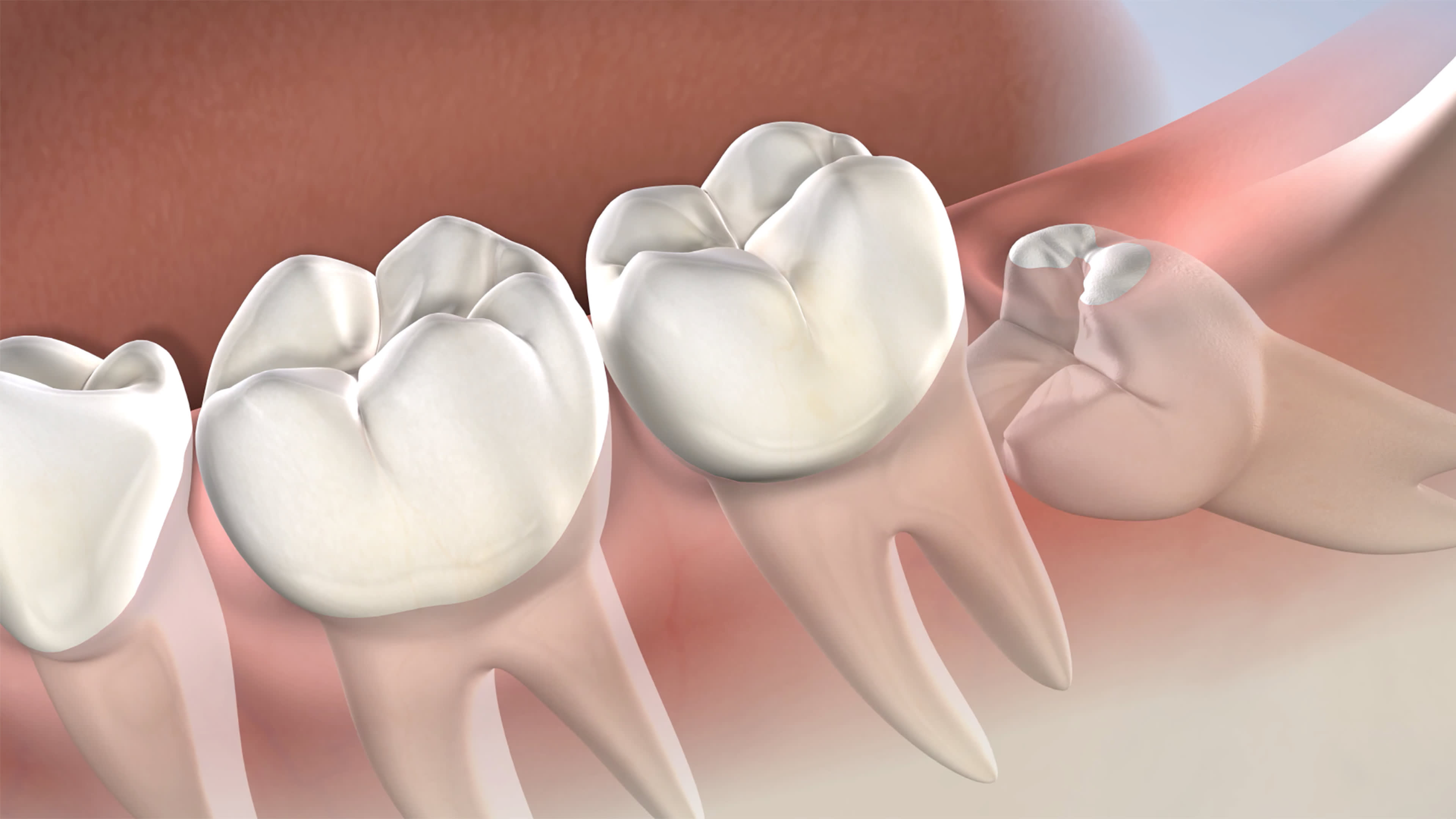 Cosmetic Dental Fillings