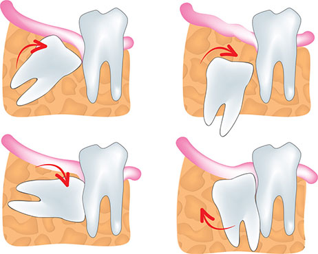 Wisdom Tooth