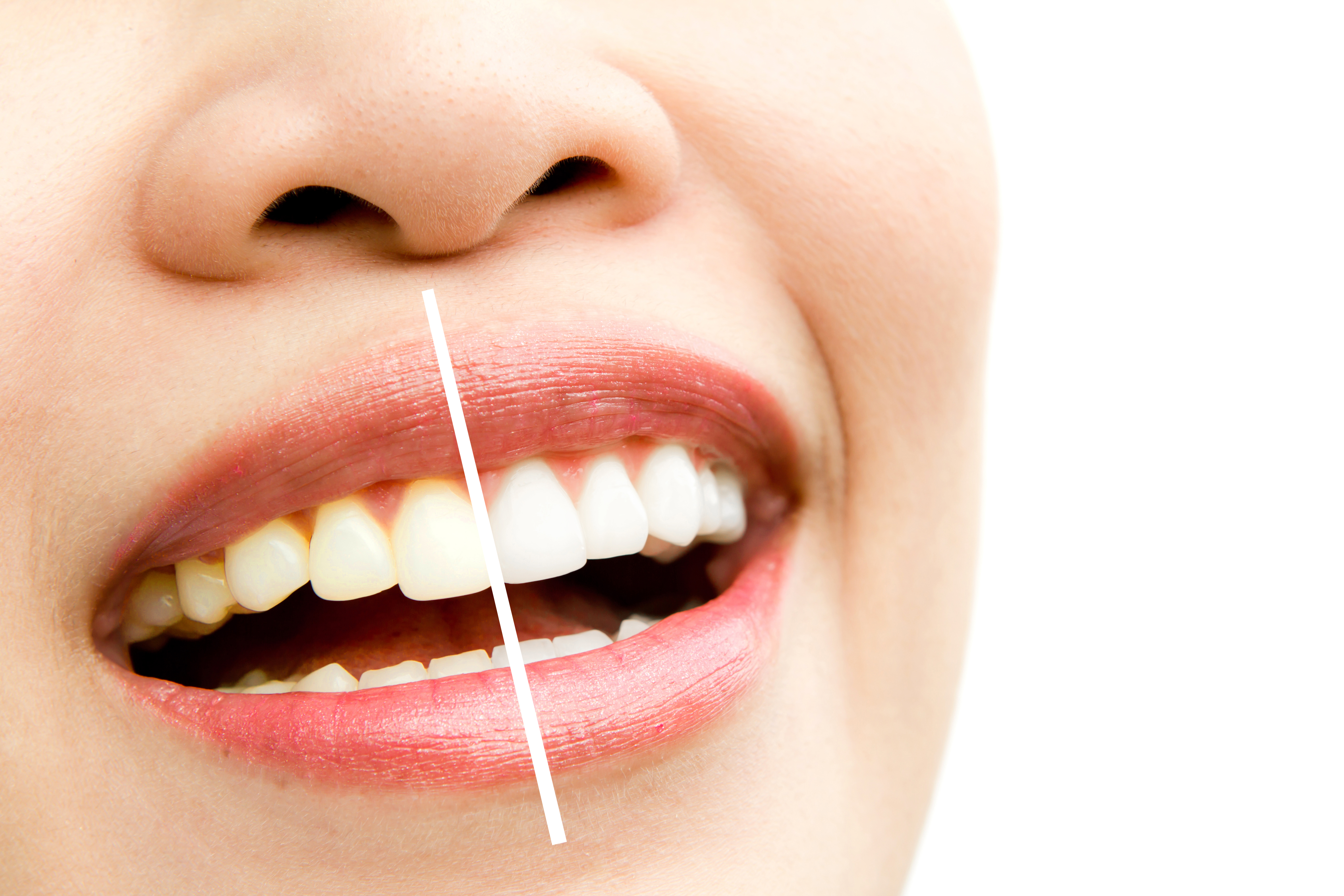 Veneers